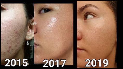 [B&A] Two Year Dermarolling and Routine Update .